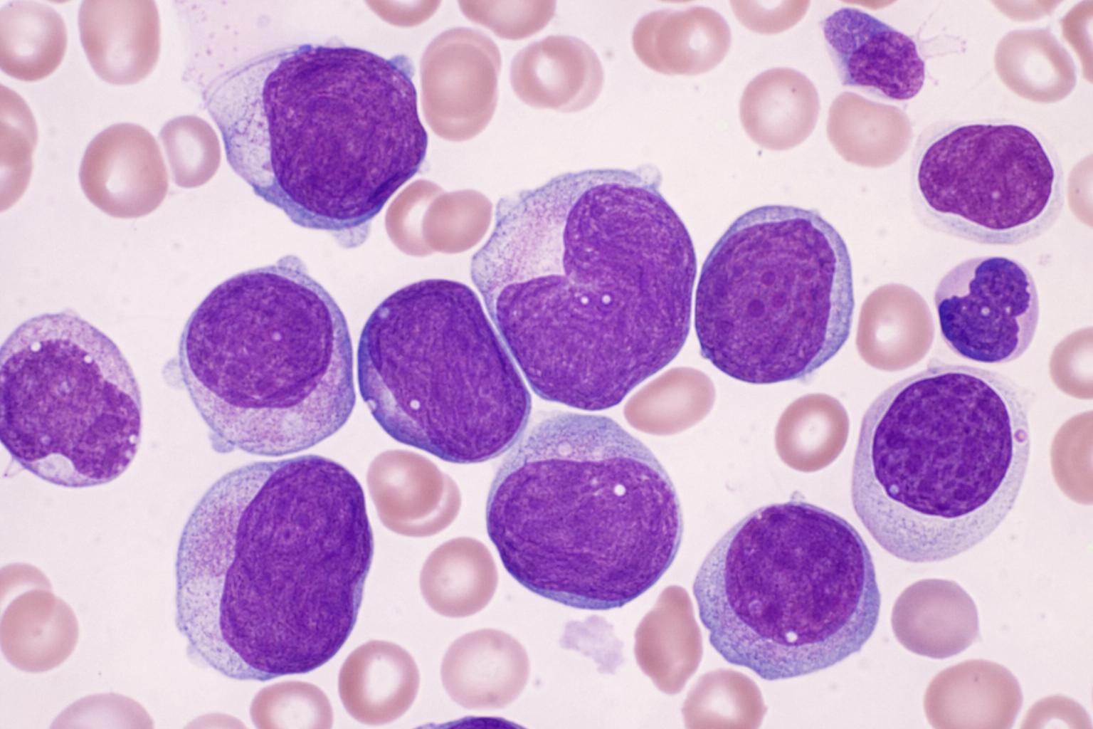 Leukemia in Canada: Symptoms, Diagnosis, Treatment Options, and Real-World Support